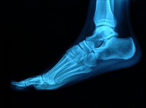 symptoms of a broken foot