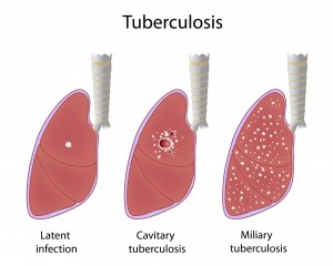 Facts About Tuberculosis