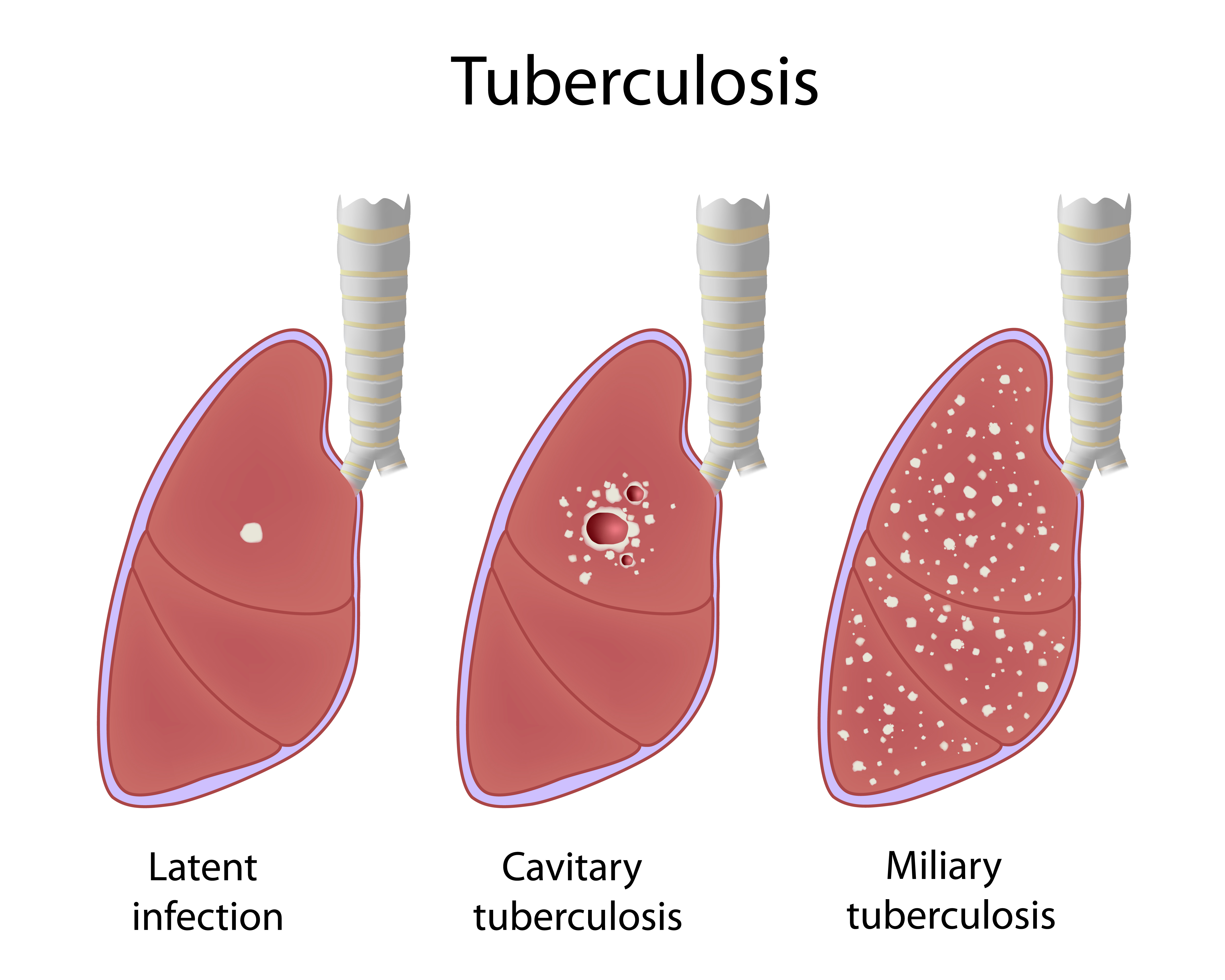 Facts About Tuberculosis: Symptoms, Vaccine, and Treatment. - Urgent