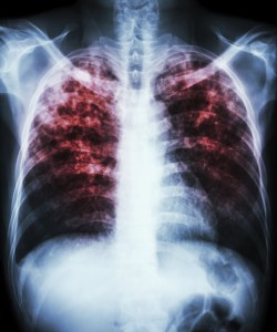 "Pulmonary tuberculosis"  Film chest x-ray show interstitial infiltration both lung due to mycobacterium tuberculosis infection