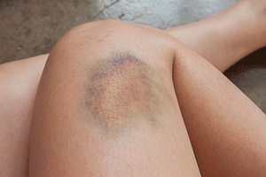 9-Strange-Reasons-You-May-Bruise-Easily