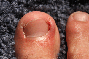 How To Relieve Painful Ingrown Toenails - Urgent Medical Care
