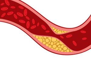 Cholesterol and Your Well-Being